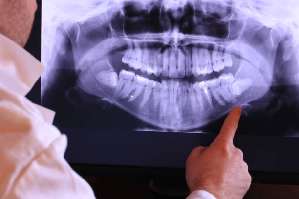 Best Emergency Wisdom Tooth Extraction in Ellicott City, MD